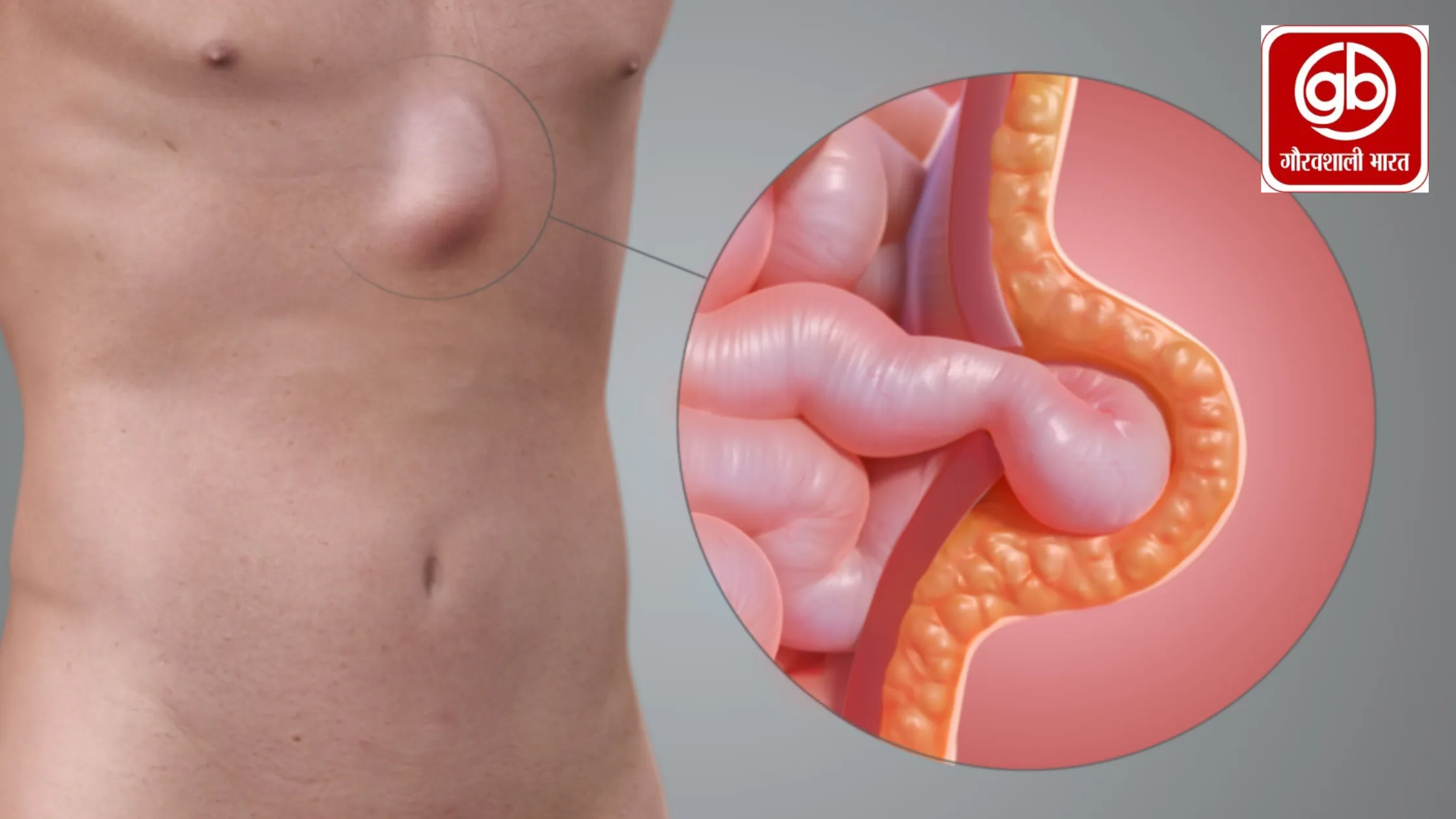 हर्निया: कारण, लक्षण, प्रकार और उपचार